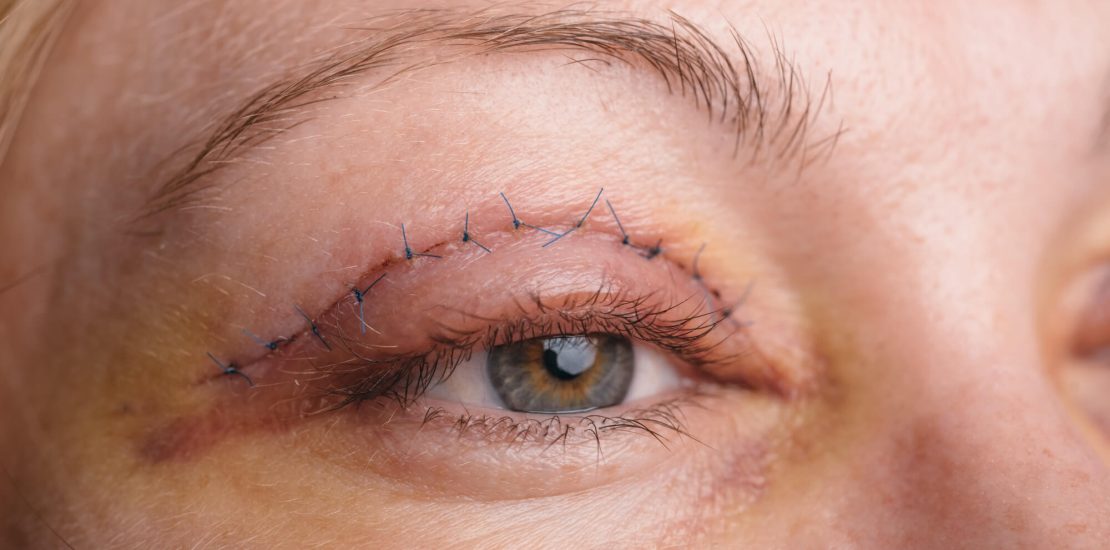 Blépharoplastie : un éclairage sur la chirurgie des paupières