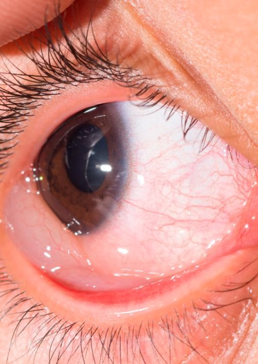 vitrectomy cost