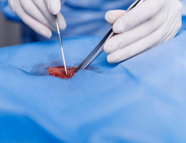 Angioplastie Tunisie