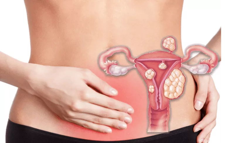 Myomectomie