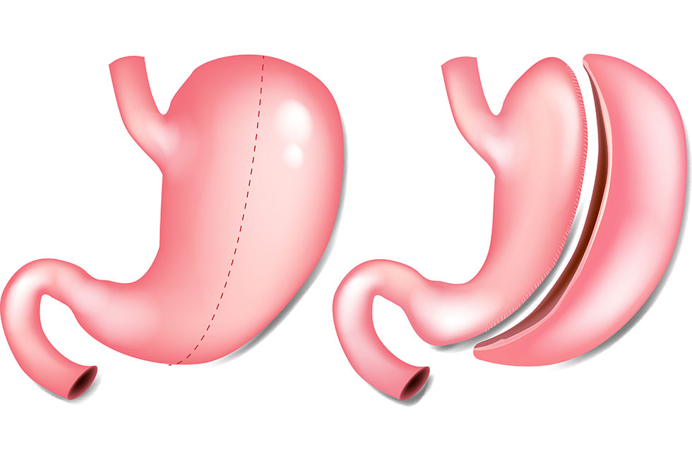 sleeve gastrectomie